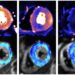 MRI images of the heart