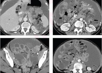 62-year-old woman who underwent pretreatment CT for suspected advanced ovarian cancer