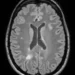 MRI scan of the brain of a patient with multiple sclerosis.