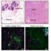 Samples of breast tissue in patients and healthy individuals