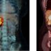 Adrenocortical carcinoma