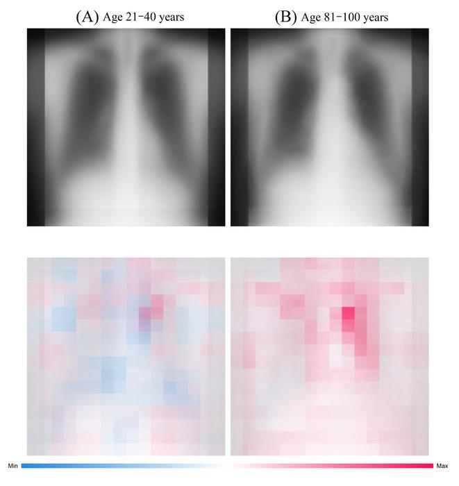 What the AI “sees” in a radiograph