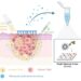 Microneedles and ultra-sensitive biomarker analysis in melanoma