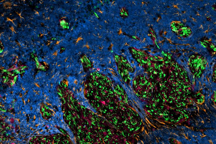 Discovery of protein-protein interaction lays foundation for future glioblastoma therapy