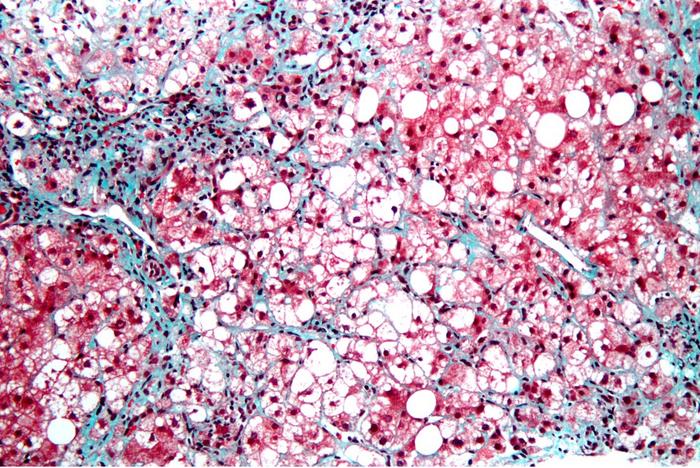 Strands of activated hepatic stellate cells (blue) create characteristic “chicken wire” fibrosis in the liver