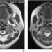 49-year-old female patient with nasopharyngeal carcinoma (NPC)