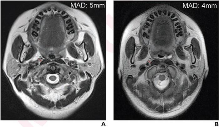 49-year-old female patient with nasopharyngeal carcinoma (NPC)