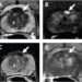 62-year-old with serum PSA level of 4.11 ng/mL. Prostate MRI shows lesion in left mid anterior transition zone.