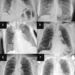 Representative chest radiographs in six patients show (A, C, E) false-positive findings and (B, D, F) false-negative findings as identified by the artificial intelligence (AI) tools.