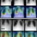 AI Combines Chest X-rays with Patient Data to Improve Diagnosis