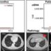 Circulating tumor DNA (ctDNA) correlates with radiology disease assessment and patient outcome