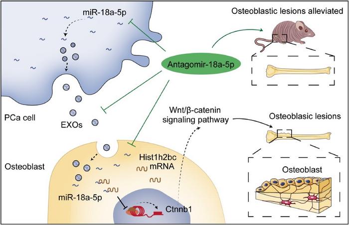 The molecular mechanism and therapeutic strategy of miR-18a-5p mediating osteoblastic lesions in PCa bone metastasis.