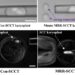 Novel procedure reduces the risk of mitochondrial disease transmission