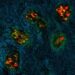 colorectal cancer cells metastasized to the liver