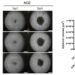 miR-451a introduced into GBC cells reduces the volume of cell aggregates