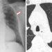 Frontal Chest X-ray