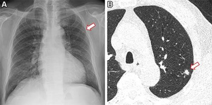 Frontal Chest X-ray