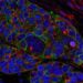 Potential Therapeutic Target for Aggressive Form of Pancreatic Cancer