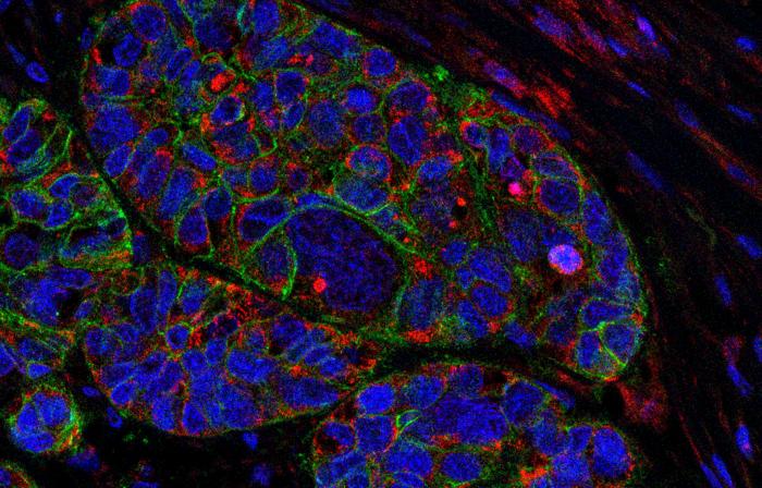 Potential Therapeutic Target for Aggressive Form of Pancreatic Cancer