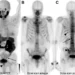 A 74-y-old man at initial staging with PSMA PET.