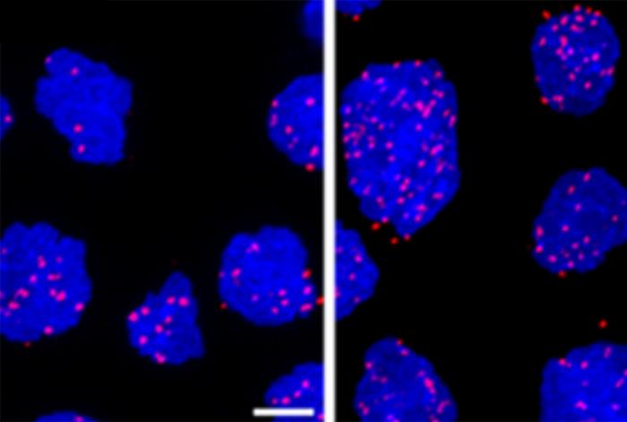 New Strategy Attacks Treatment-Resistant Lymphomas