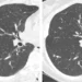 Screening Sharply Improves Lung Cancer Long-term Survival