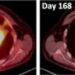 Chest scans showing lung tumors