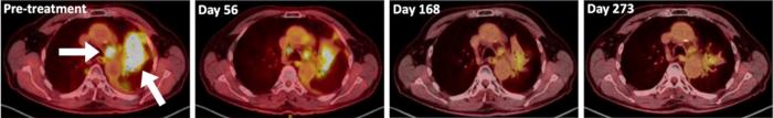 Chest scans showing lung tumors