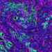 Pancreatic cancer fibroblasts