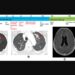 Figure 1: Treatment timeline with chest computed tomography (CT) and brain magnetic resonance images (MRI) on osimertinib.