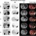 Performance of 68Ga-pentixafor PET/CT in PA patients with different adrenal micronodules.