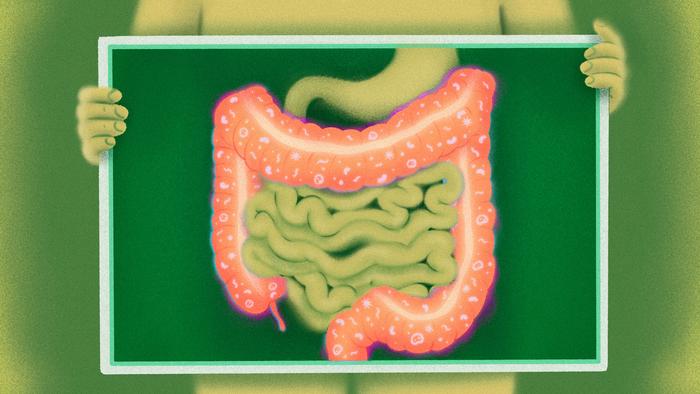 Immunotherapy Colitis