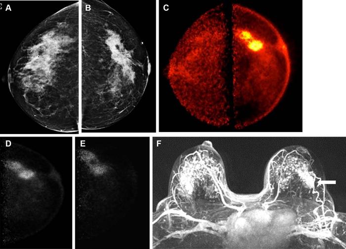 Images obtained in a 50-year-old female patient with a new biopsy-proven malignant lesion in the left breast.