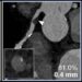 Coronary CT Angiography