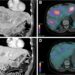 Patient who received 3 [90Y]Y-DOTATOC and 1 [177Lu]Lu-DOTATOC therapy cycles