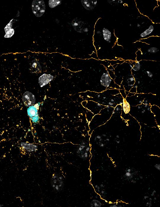 Dying Oligodendrocyte