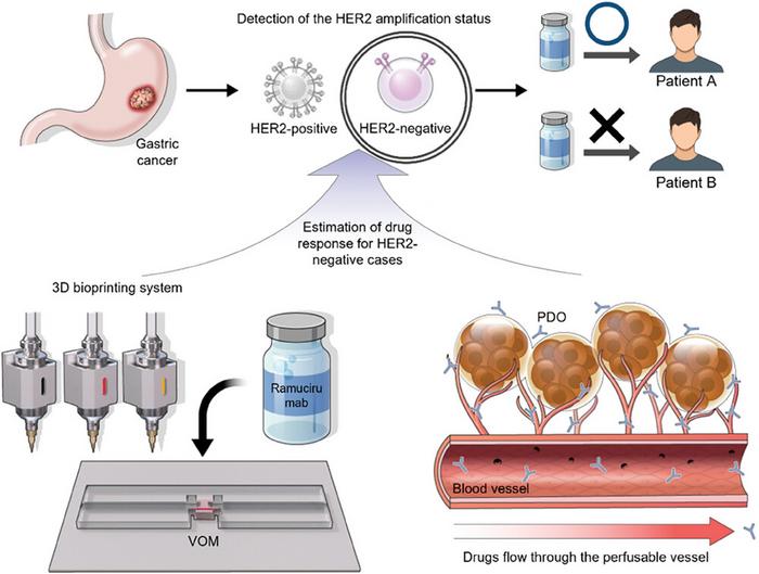 Revolutionizing gastric cancer treatment through personalized 3D bioprinting