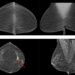 Mammograms with and without cancer