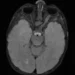 NF1-linked optic glioma