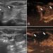 Ultrasound images in patient with multifocal papillary thyroid carcinoma