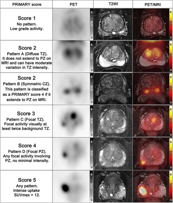 PET/MRI accurately classifies prostate cancer patients, offers potential to avoid unnecessary biopsies