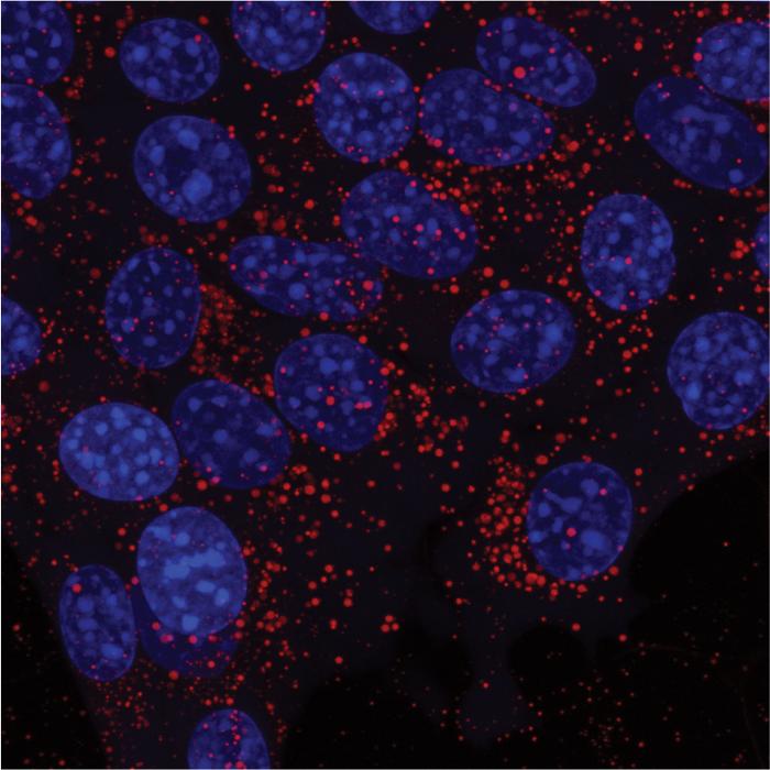 Cancer cells gathering lipid droplets