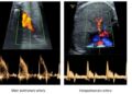 Pulmonary vascular reactivity in growth restricted fetuses using computational modelling and machine learning analysis of fetal Doppler waveforms