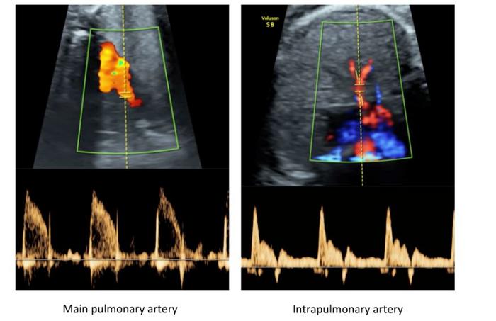 A study by UPF and BCNatal opens the door to designing therapies to improve lung development in growth-restricted fetuses