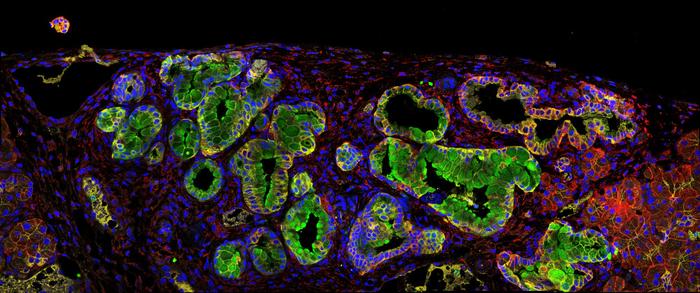 Pancreatic tumor