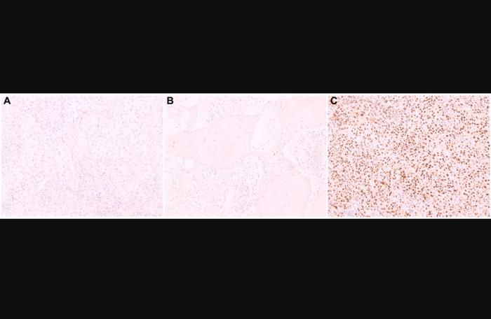 Cyclin D1 expression in penile cancer