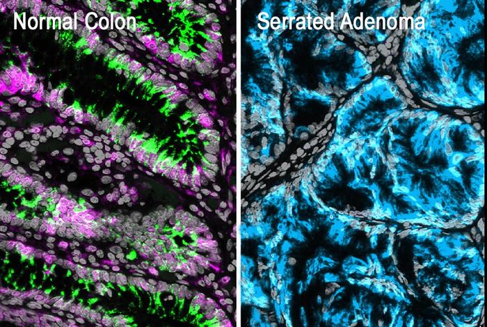 Identifying the Initial Steps in Colorectal Cancer Formation