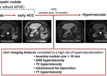 Hepatobiliary Phase Hypointense Nodules without Arterial Phase Hyperenhancement