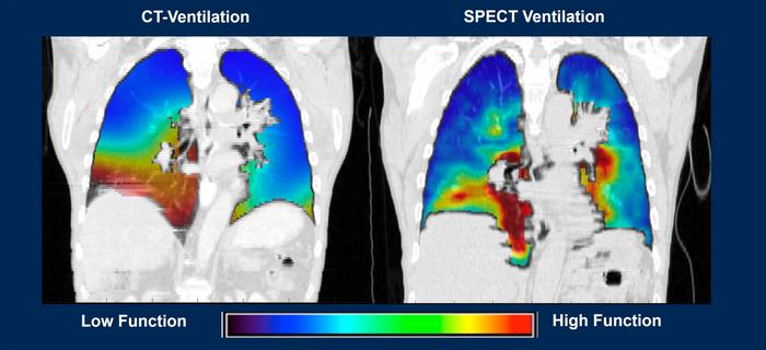 New imaging software improves lung diagnosis for 30% of patients who can’t tolerate contrast dye; has added diagnostic benefits for all patients