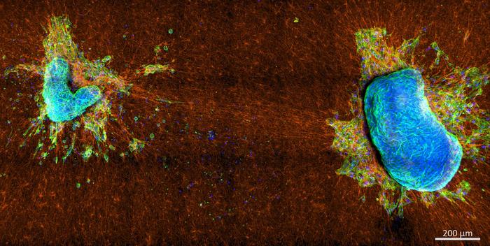 Two malignant mixed mullerian tumor explants on collagen network